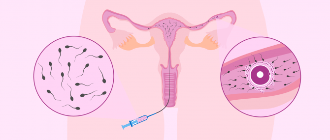 Imagen: Intrauterine insemination