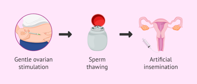 Imagen: Steps to perform an IUI with donor sperm