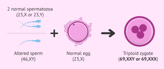 Imagen: Partial hydatidiform mole