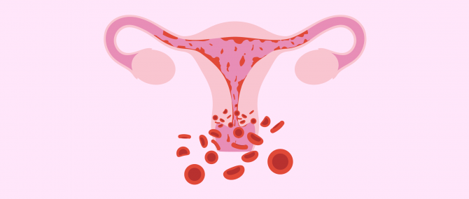 Heavy menstrual periods and endometrial ablation