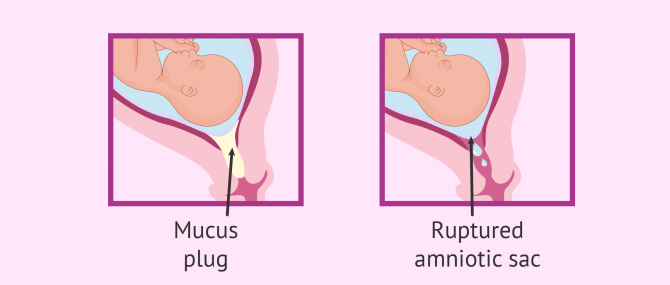 am i leaking amniotic fluid