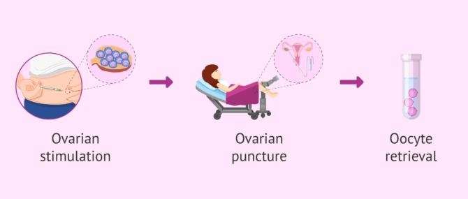 Imagen: Why does ovarian puncture require anaesthesia?