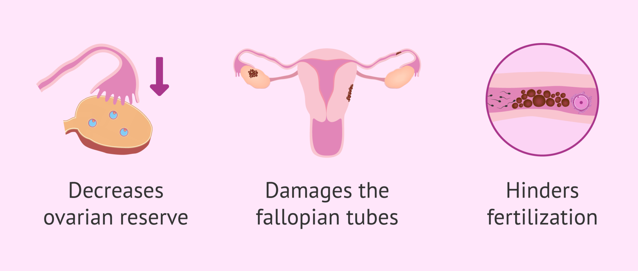 What effects does endometriosis have on fertility?