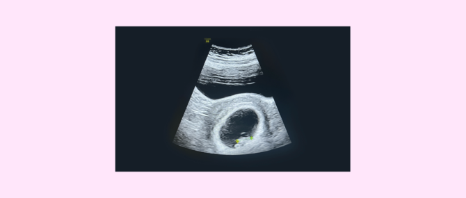 Imagen: First gestational 2D ultrasound