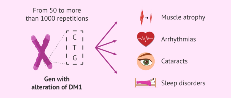 Causes and symptoms of Steinert's myotonic dystrophy