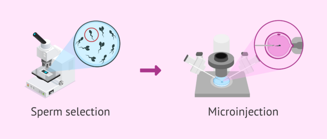 Imagen: IMSI and teratozoospermia