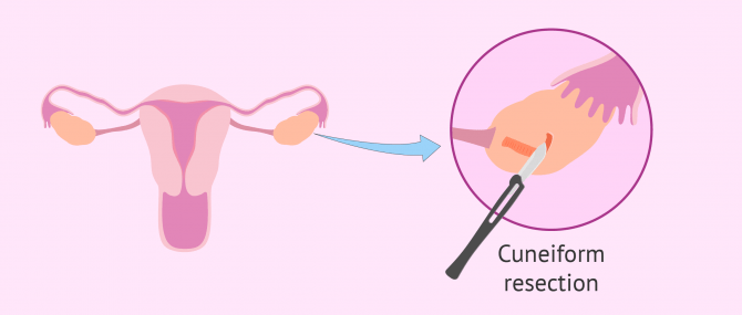 Cuneiform resection