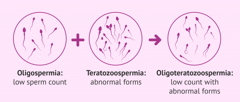 Definition Of Oligoteratozoospermia