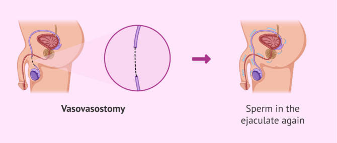 Imagen: Vasovasostomy