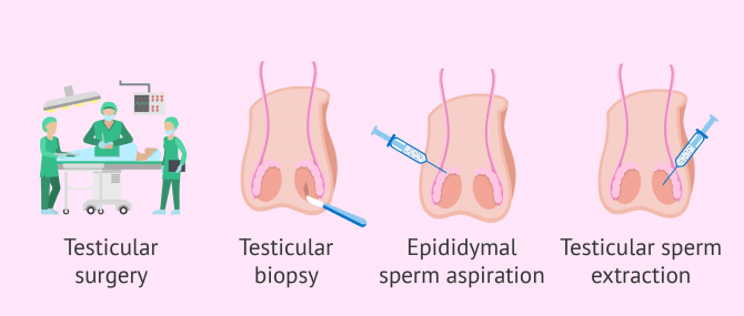 Pregnancy with obstructive azoospermia