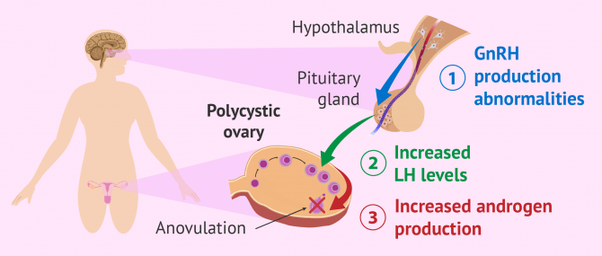 Hypothalamic amenorrhea and PCOS