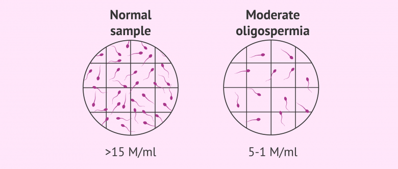 The Different Grades Of Oligozoospermia: Mild, Moderate And Severe