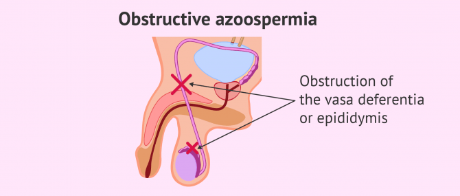 Obstructive azoospermia causes