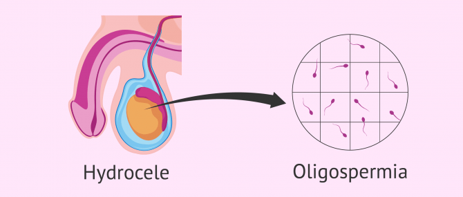 Oligozoospermia and hydrocele