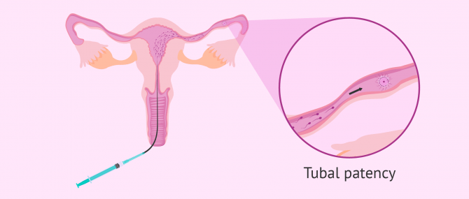 Imagen: Egg fertilization in Fallopian tube