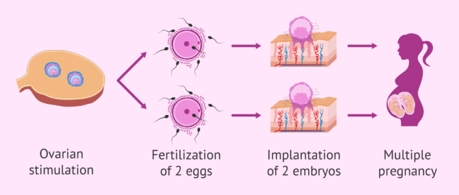 Imagen: Multiple pregnancy and assisted reproduction