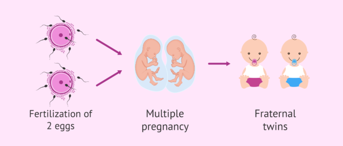 Imagen: Twin pregnancy after assisted reproduction treatment