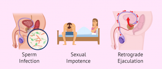 Imagen: Infertility by post-testicular factor