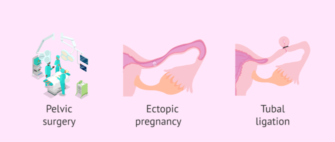 Other causes of tubal factor