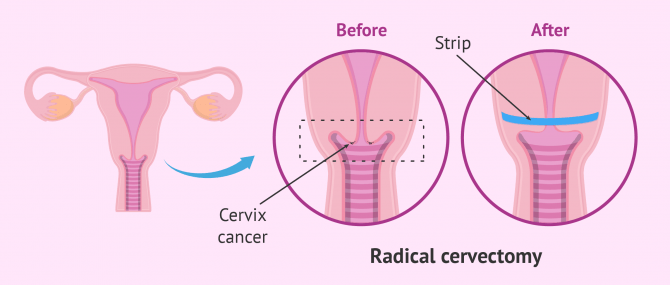 Imagen: cervicalectomy