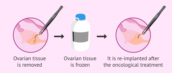 Imagen: ovarian tissue conservation