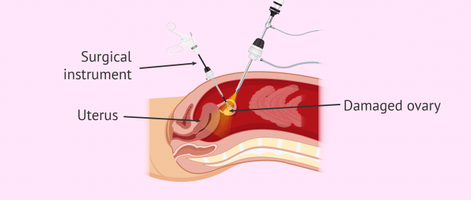 Imagen: Ovaries retrieval