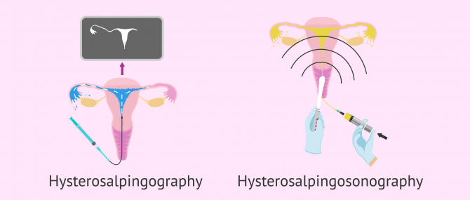 Imagen: Types of hysterosalpingography