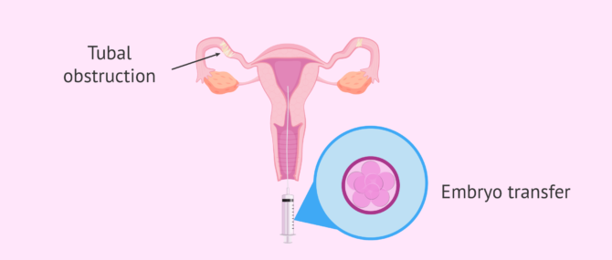 Imagen: IVF with tubal obstruction