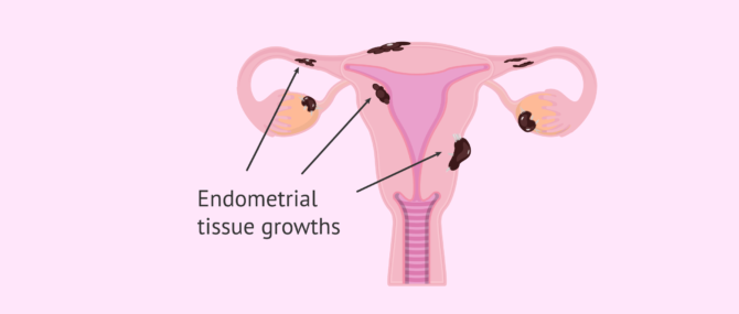 Imagen: Areas of the female reproductive system with endometriosis