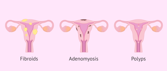 Imagen: Uterine tumors