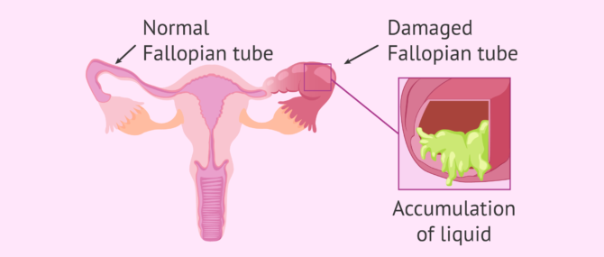 Imagen: Normal Fallopian tube and Fallopian tube with hydrosalpinx