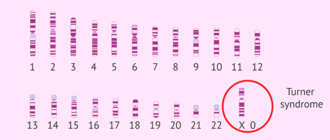 Imagen: Turner syndrome Karyotype