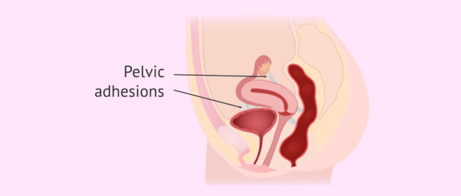 Imagen: Pelvic adhesions in women