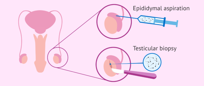 Imagen: ICSI in cases of severe male infertility