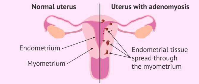 Imagen: Comparation between healthy uterus and uterine adenomyosis