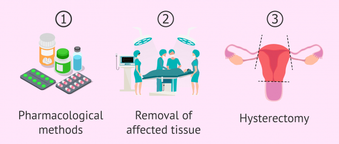 Imagen: Treatment of adenomyosis