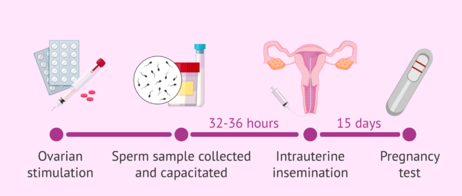 Imagen: How does IUI happen?