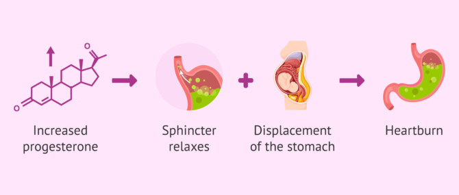 Imagen: What causes heartburn in pregnancy?