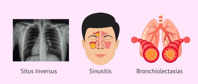 Imagen: Clinic triad of kartagener's syndrome