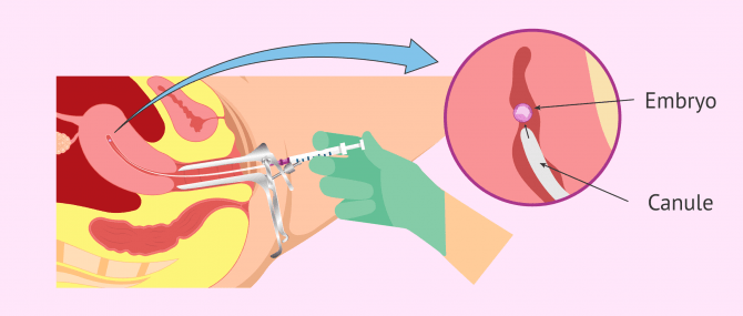 Imagen: The embryo transfer phase