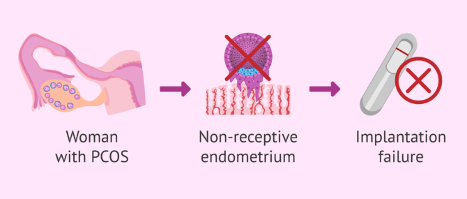 Imagen: Do women with PCOS have a receptive endometrium?