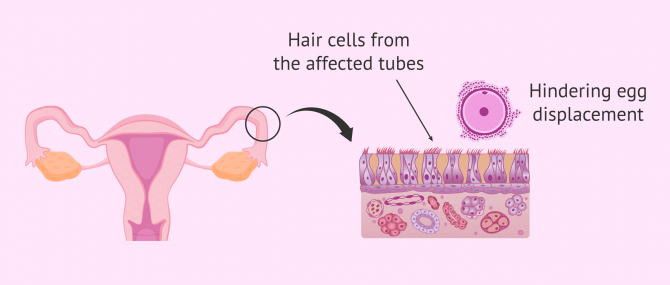 Imagen: Female infertility due to kartagener's syndrome