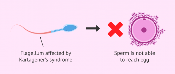 Imagen: Male Infertility due to Kartagener's Syndrome