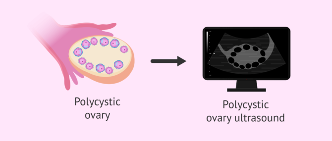 Imagen: Polycystic ovary ultrasound