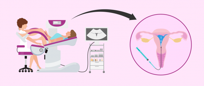 Imagen: How is hysterosalpingography performed