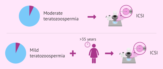 Imagen: IVF to achieve pregnancy with moderate teratozoospermia