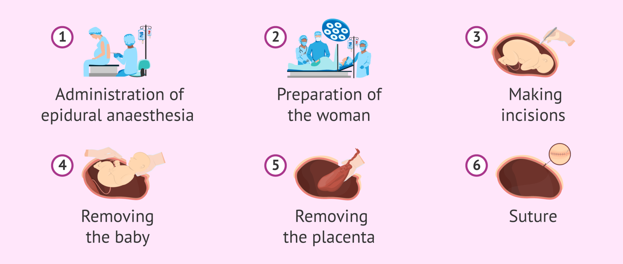 Step By Step Of A Planned Caesarean Section