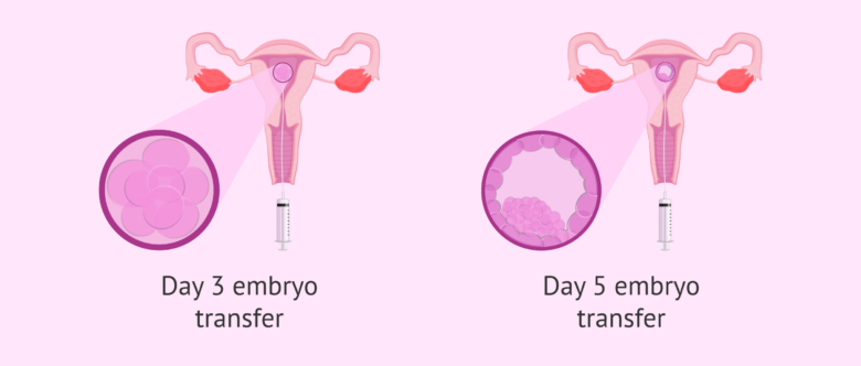 Embryo transfer: when and how is it done?