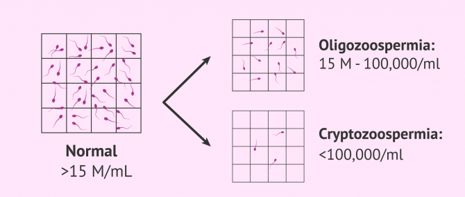 Imagen: Normal, oligozoospermic and cryptozoospermic semen sample