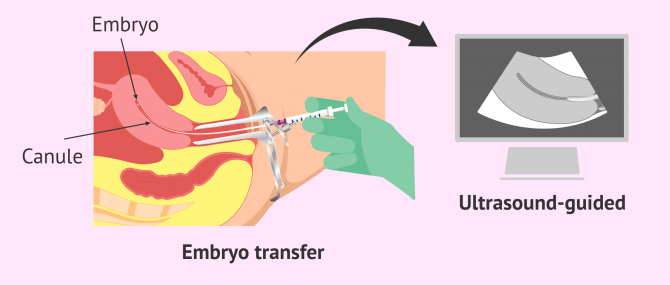 Imagen: Ultrasound-guided embryo transfer